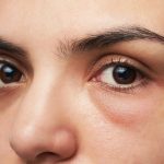 como ocultar las ojeras oscuras