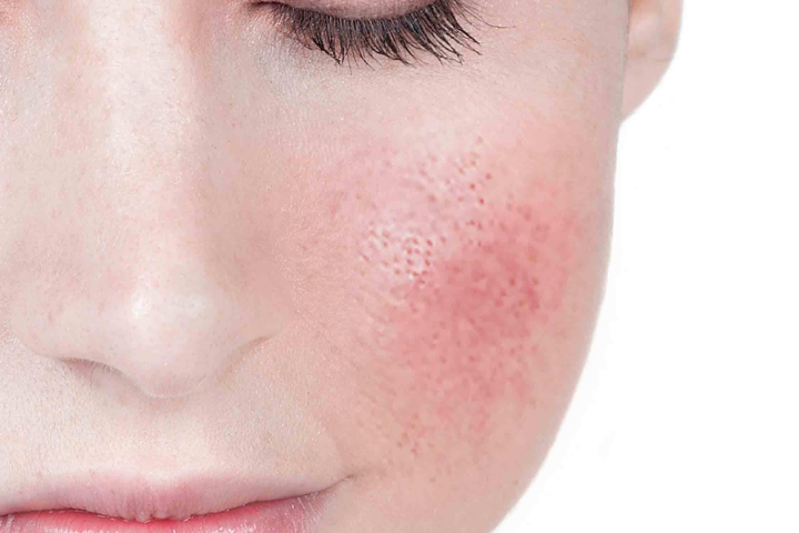 Cuidado de la piel en personas con rosácea